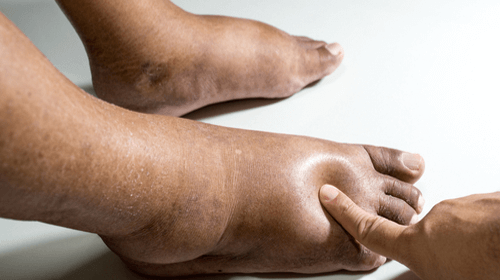  Cele mai bune 8 remedii pentru tratarea picioarelor umflate