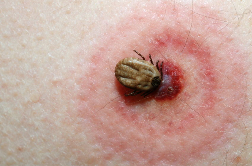  ALERTĂ de căpușe in județul Bistrița-Năsăud! 56 de persoane mușcate de insecte, 3 dintre ele diagnosticate cu boala Lyme