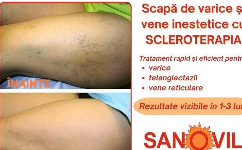 Scapă de varice și vene inestetice la Policlinica Nouă Sanovil